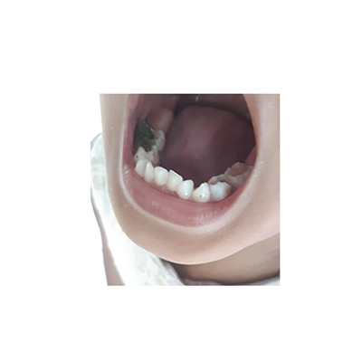 Traditional recipe Treating toothache from Legetan